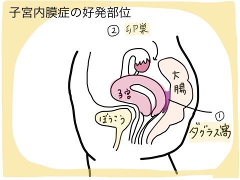 腹膜子宮内膜症ではどのような合併症が起こる可能性がありますか?